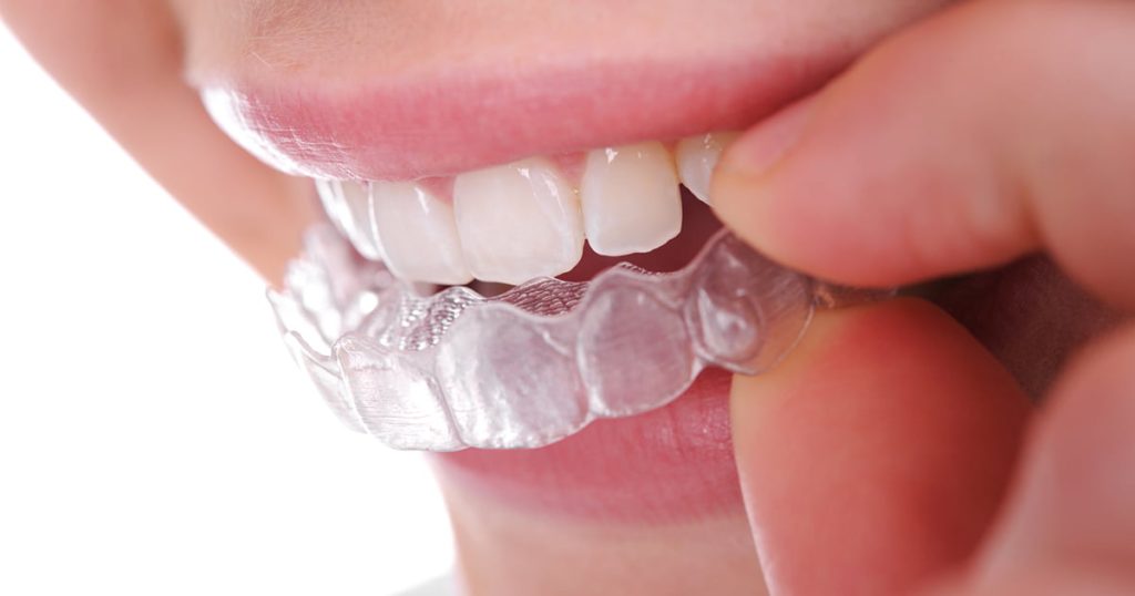 Why Invisalign in London is a Game-Changer for Orthodontic Patients